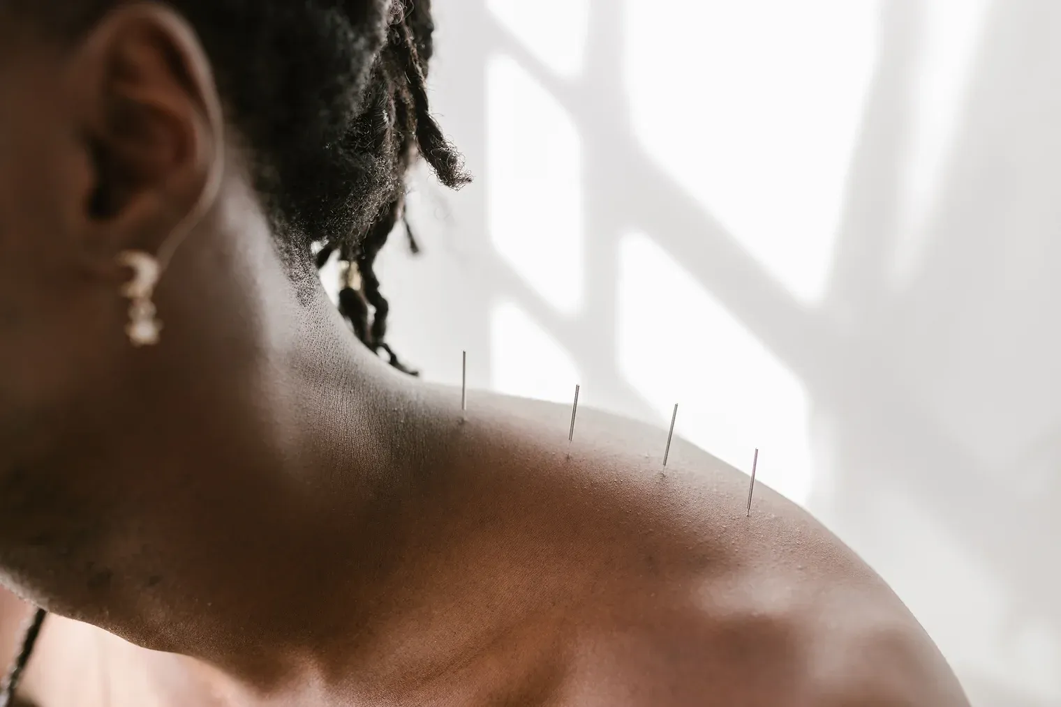 Acupuncture treatment